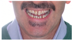 Cosa sono le veneers, faccette dentali estetiche. - Dentista Roma Eur -  Centro odontoiatrico iDea