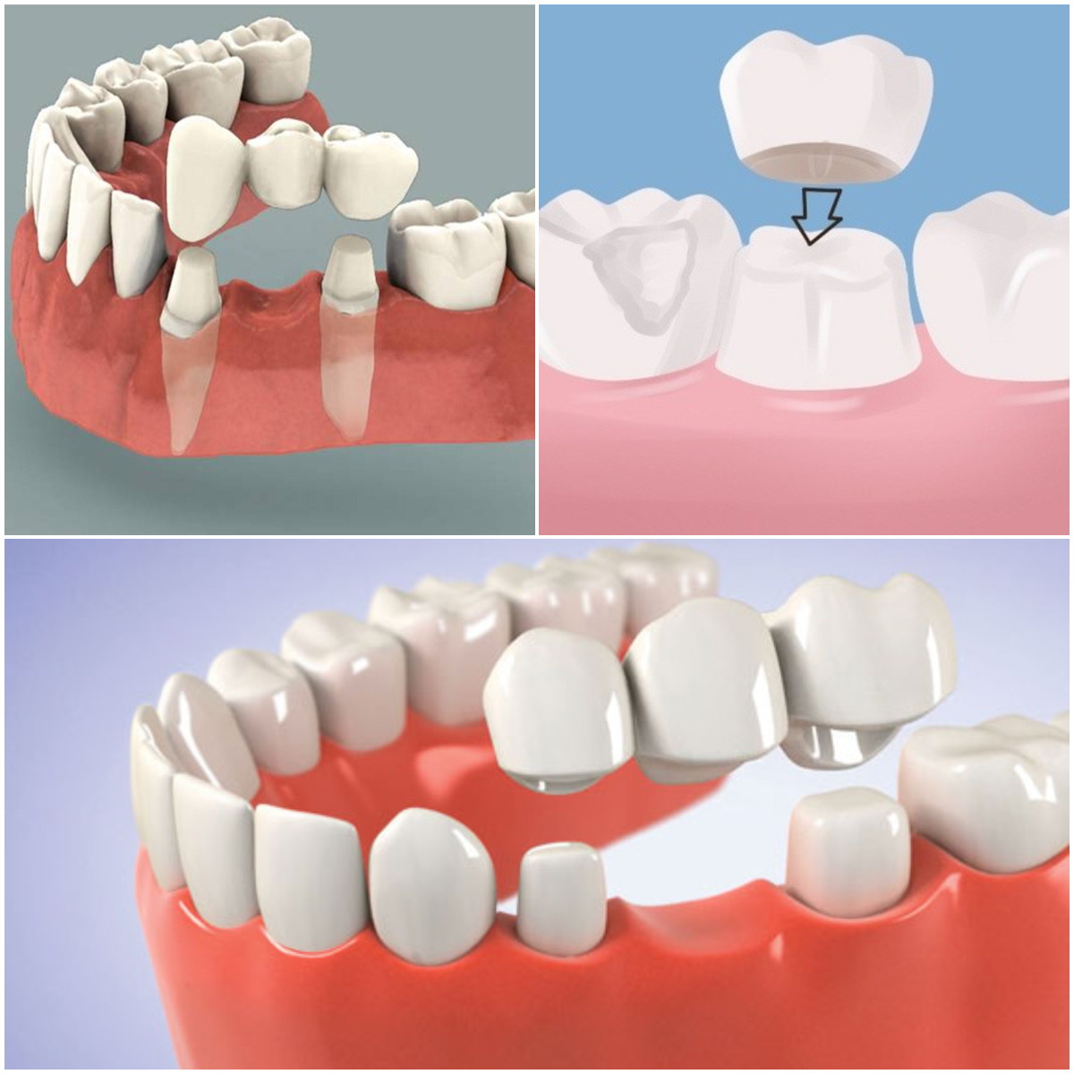 Porta dente da latte # » Un Filo Avanti