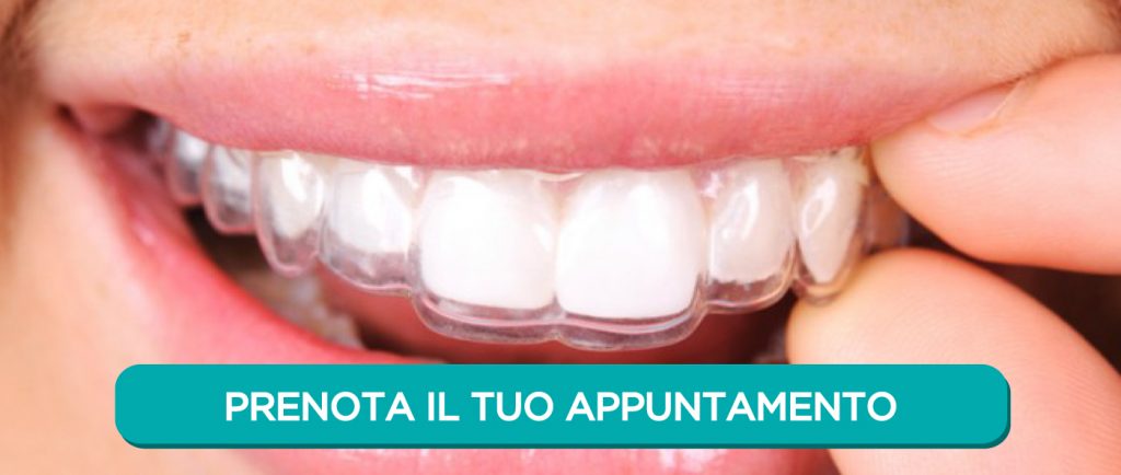 Apparecchio ortodontico per bambini - Dentisti Roma Eur